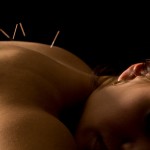 acupuncture